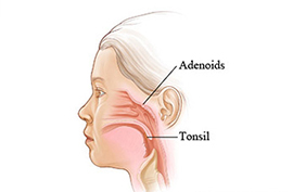Adenoids treatment at Nitson Homeopathy