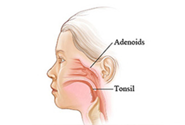 Adenoids